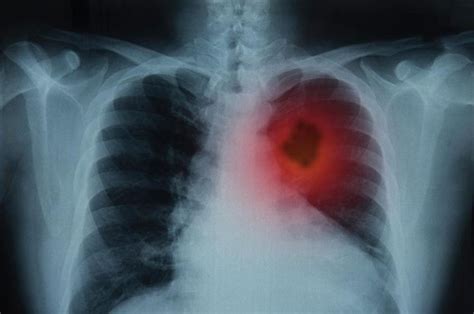 akciğerlerde iltihap neden olur